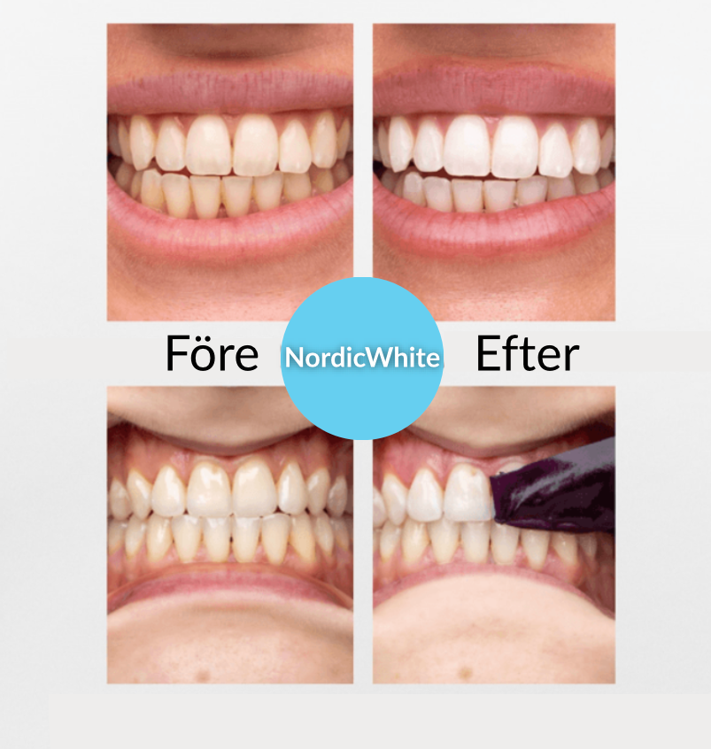 Blekningsremsor - Lösningen på dina gula tänder!